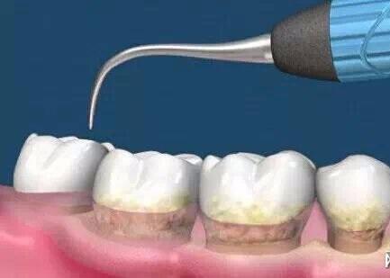 杭州美奧口腔怎么樣?洗牙能去除煙漬嗎-易網健康<a href=http://www.jsjjzhkt.cn/jkys/ target=_blank class=infotextkey>養生</a>網 杭州美奧口腔怎么樣?洗牙能去除煙漬嗎