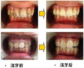 杭州美奧口腔怎么樣?洗牙能去除煙漬嗎-易網健康養生網 杭州美奧口腔怎么樣?洗牙能去除煙漬嗎