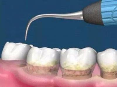 杭州美奧口腔怎么樣？洗牙能去除煙漬嗎