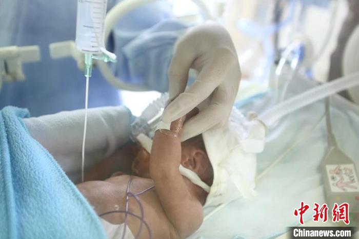 報告稱：中國極早產兒、極低出生體重早產兒存活率明顯提高