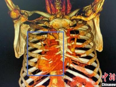 上海市權威專家獨辟新徑取得成功救護與生俱來“異”心人