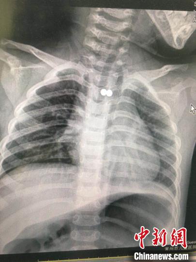 男童誤食兩顆磁力珠 專家通力配合將磁力珠取出