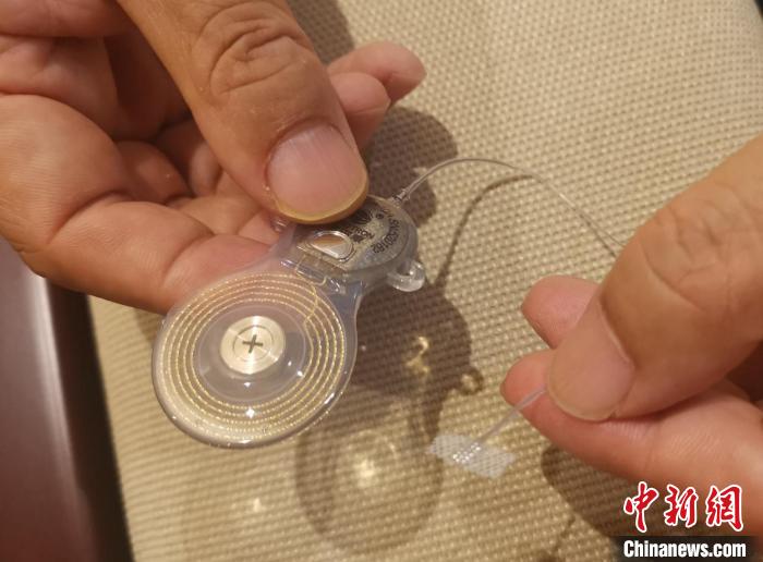 “國產人工聽覺腦干植入系統” 成果轉化簽約 擺脫進口依賴