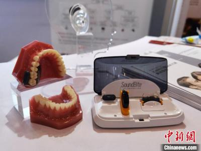 牙骨傳導(dǎo)為聽(tīng)力重建領(lǐng)域注入活力 專(zhuān)家呼吁盡早干預(yù)術(shù)后聽(tīng)力問(wèn)題