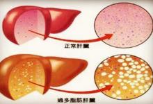 從脂肪肝到肝癌只需4步！做錯這6件事，最容易得脂肪肝！