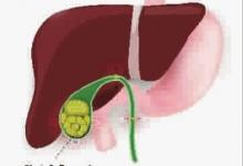 如何護理膽結石?高危人群要注意