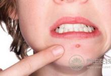 如何應對痘痘來襲?