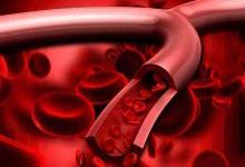 小心!血管都是被這幾個壞習慣毀掉的