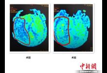吃外賣、熬夜、少運動 小白領突發腦梗
