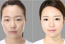 整容風水學 不可不知的整容禁忌