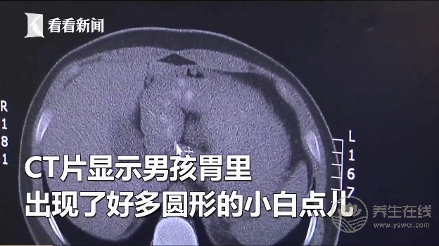 男孩因貪杯珍珠奶茶患上急性膽囊炎 男孩因貪杯珍珠奶茶患上急性膽囊炎