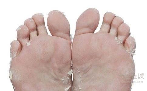 腳氣也是一種病，做到這一點能夠有效預防腳氣