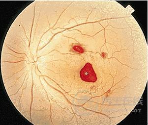 這兩類食物很毒,最容易導致肝癌,很多人還不注意 這兩類食物很毒,最容易導致肝癌,很多人還不注意