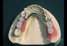 義齒有哪幾類(lèi),什么是義齒