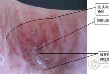 腳氣也是一種病,做到這一點能夠有效預防腳氣
