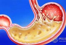 胃脹、胃酸、胃不舒服?簡單6招,還自己一個好胃