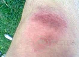 有哪些食物可以有助于消腫? 有哪些食物可以有助于消腫?