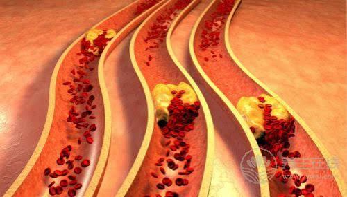 這5種食物堪稱“血管清道夫”，血管垃圾一掃空