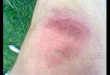 有哪些食物可以有助于消腫?