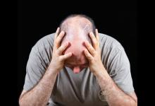 注意!這些因素都是導致禿頂的“導火線”