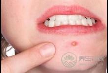 經期狂長痘痘怎么回事？排毒調理才是關鍵