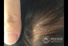 頭皮屑多很尷尬?不妨多吃這幾種食物