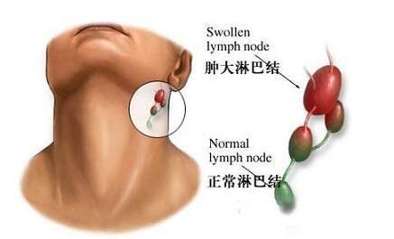 淋巴結(jié)排毒的方法以及定期排毒的好處 淋巴結(jié)排毒的方法以及定期排毒的好處