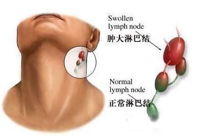淋巴結排毒的方法以及定期排毒的好處