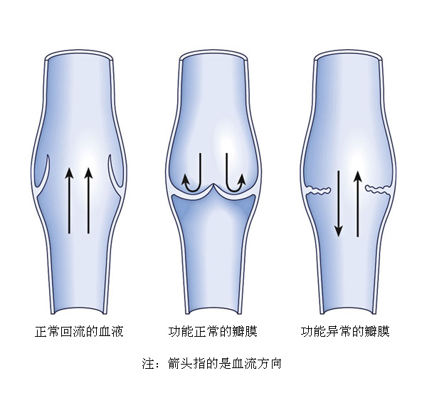 小腿靜脈曲張的治療方法如何治根 小腿靜脈曲張的治療方法如何治根