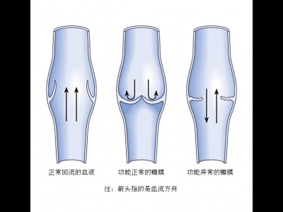 小腿靜脈曲張的治療方法如何治根