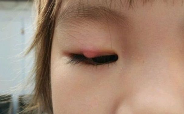 長針眼的處理方法和針眼的治療方法