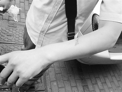 手臂出現肌肉拉傷情況需要如何處理 手臂出現肌肉拉傷情況需要如何處理