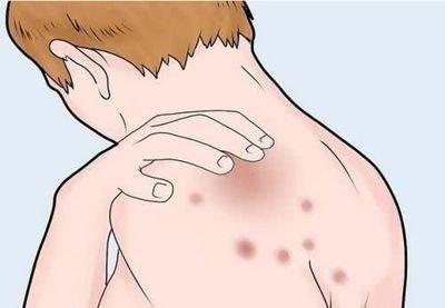 導致濕疹出現的原因以及治療方法