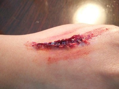 身體受傷用什么消炎對(duì)傷口效果最好 身體受傷用什么消炎對(duì)傷口效果最好