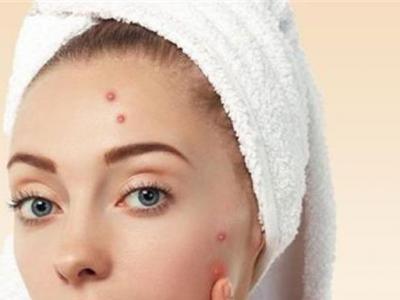 長痘痘在排完痘痘之后抹什么消炎