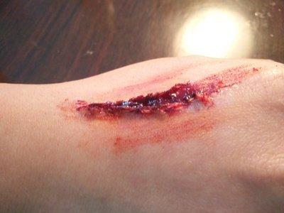 身體受傷用什么消炎對(duì)傷口效果最好