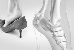 滑囊炎分為哪幾種要怎樣做好消炎的工作