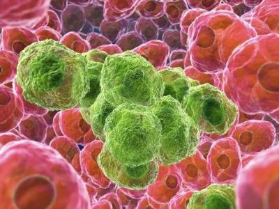 如果人體中出現腫瘤會有哪些前兆