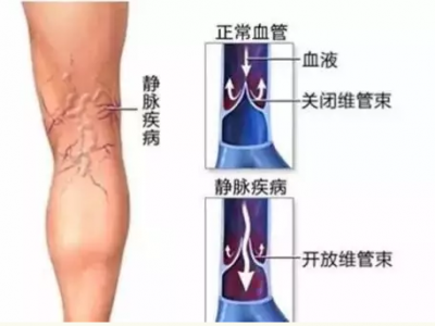 喝酒是否會影響到靜脈曲張患者的健康