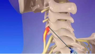 什么是神經根損傷應該如何治療損傷-易網健康<a href=http://www.jsjjzhkt.cn/jkys/ target=_blank class=infotextkey>養生</a>網 什么是神經根損傷應該如何治療損傷