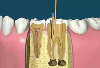 殺牙神經(jīng)對(duì)于身體的好處與壞處有哪些