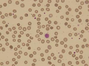 捐獻(xiàn)血小板會(huì)對(duì)身體產(chǎn)生哪些負(fù)面影響