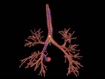 中醫(yī)有哪些治療支氣管炎的好方法