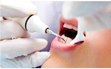 洗牙通常來說需要多長時間洗干凈