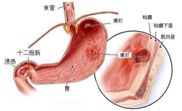消化性潰瘍分為哪些不同的類型會有哪些表現-易網健康<a href=http://www.jsjjzhkt.cn/jkys/ target=_blank class=infotextkey>養生</a>網 消化性潰瘍分為哪些不同的類型會有哪些表現