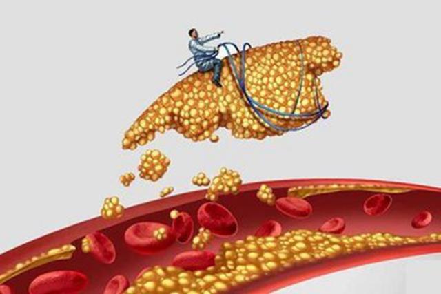甘油三酯高的原因以及如何降低甘油三酯