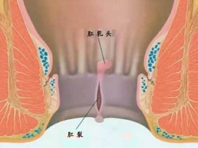 四種肛腸疾病即將出現(xiàn)的早期癥狀
