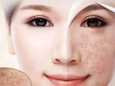 導致臉上長斑的原因以及有哪些能祛斑的中藥