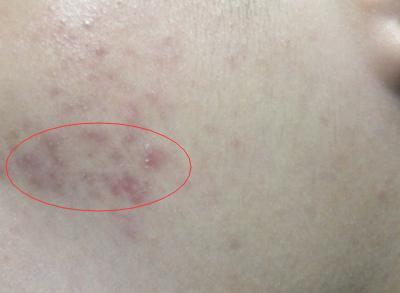 想要去除痘印有哪些比較好的方法