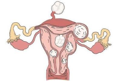 小的子宮肌瘤可以通過(guò)這樣食療進(jìn)行改善